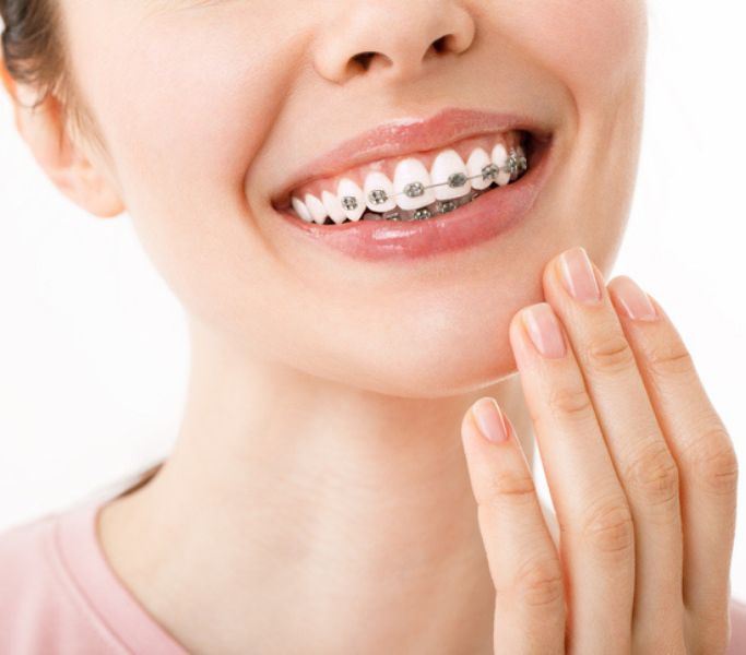 mujer mostrando su ortodoncia
