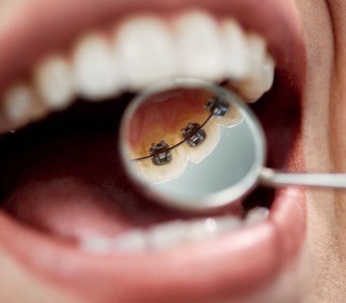 Dentista mostrando ortodoncia lingual en gandia