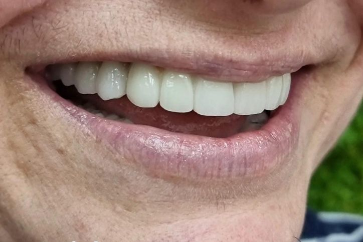 mujer con prótesis dental en Gandia