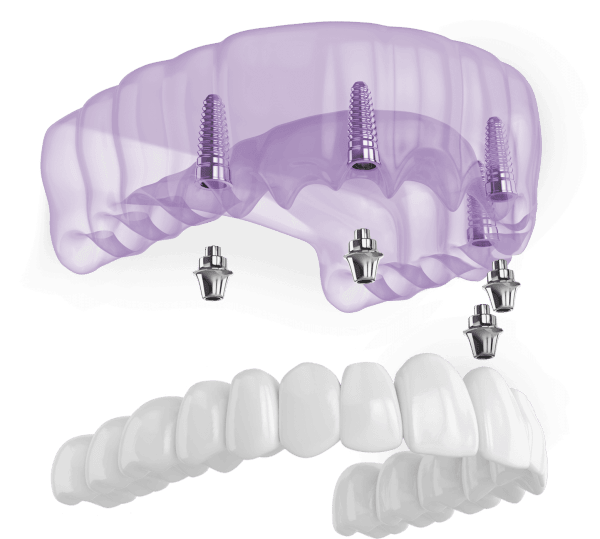 que son los implantes dentales