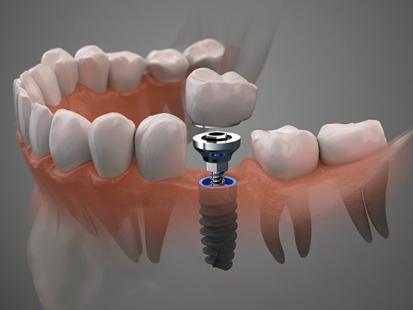 partes de un implante dental