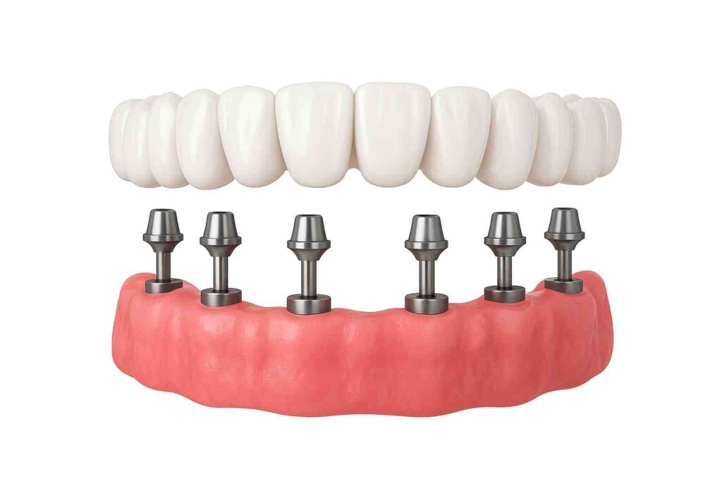 Prótesis fija sobre 6 implantes