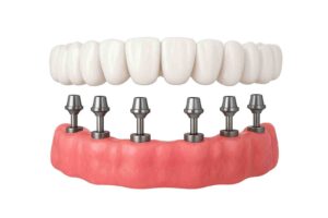 Prótesis fija sobre 6 implantes